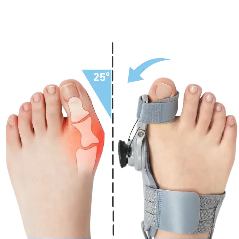 HalluxHelper™ Bunion Corrector